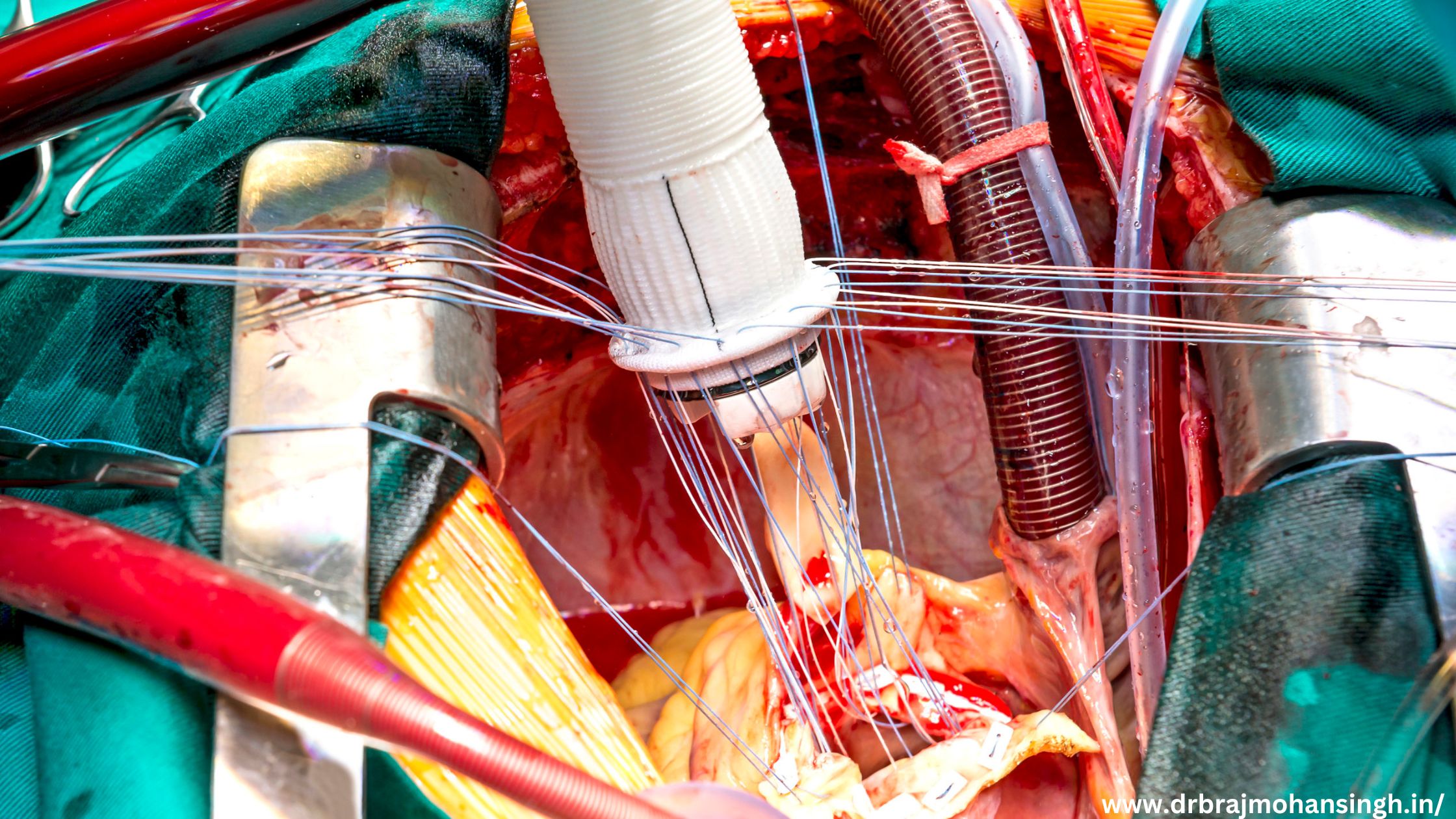 Best Aortic Surgeon In Ahmedabad - Dr. Brajmohan Singh