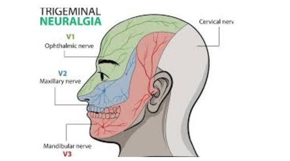 Trigeminal Neuralgia Treatment in Kolkata: A Proven Track Record of Success