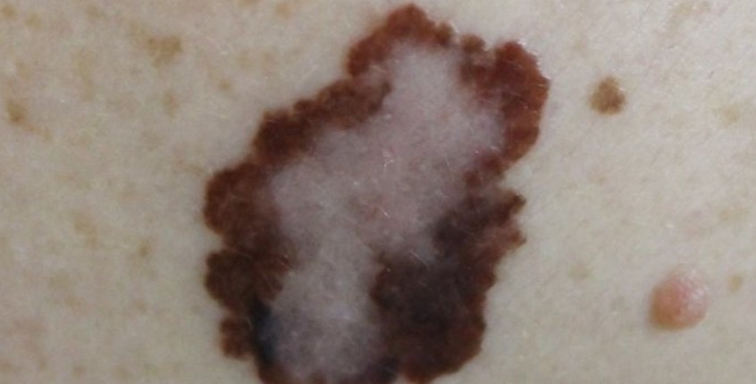 wrinkles treatment Mission Viejo CA