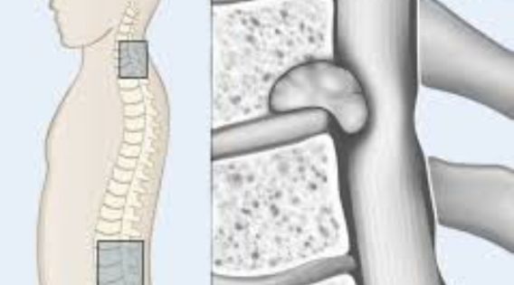 Top Neuro Spine Surgeon in India Leads Innovative Spine Tumor Therapies