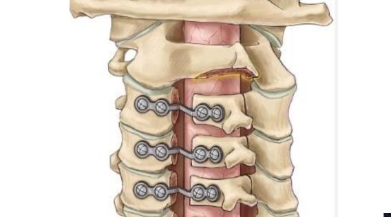 Best Cervical Spine Surgeon in India Explains the Benefits of Personalized Surgical Planning