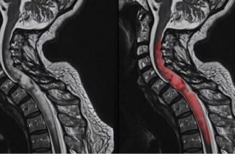 Living After Spine Tumor Surgery: Rehabilitation and Quality of Life
