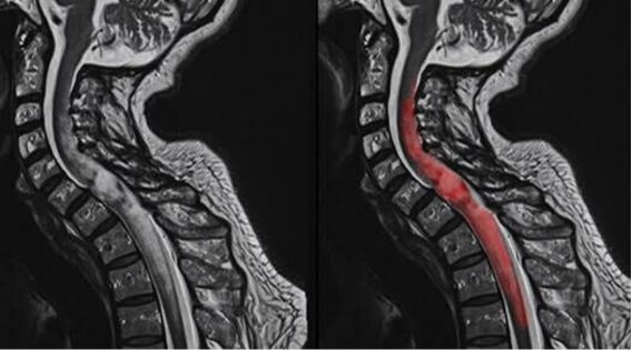 Living After Spine Tumor Surgery: Rehabilitation and Quality of Life