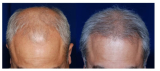 Platelet Rich Plasma Hair Loss Treatment New Jersey: What to Expect