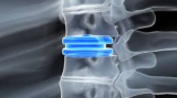 Advanced Cervical Spine Surgery & Disc Replacement Options in Kolkata
