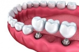 2019 Global Dental Devices Market: Key Players, Consumer Need, Forecast 2025