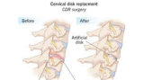 Disc Replacement in Kolkata – Consult the Best Cervical Spine Surgeon for Expert Care