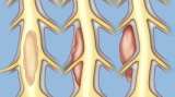 Early Signs of Spine Tumors You Shouldn’t Ignore