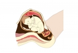 What To Do If Your Baby Is In A Breech Position?