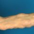 Disc Replacement in Kolkata – Consult the Best Cervical Spine Surgeon for Expert Care